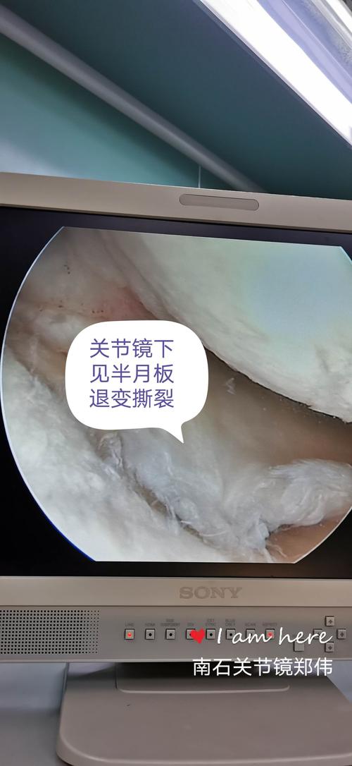 关节镜下可见滑膜增生明显,合并关节内游离体,半月板退变撕裂