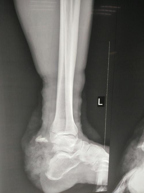 跟骨结节撕脱骨折