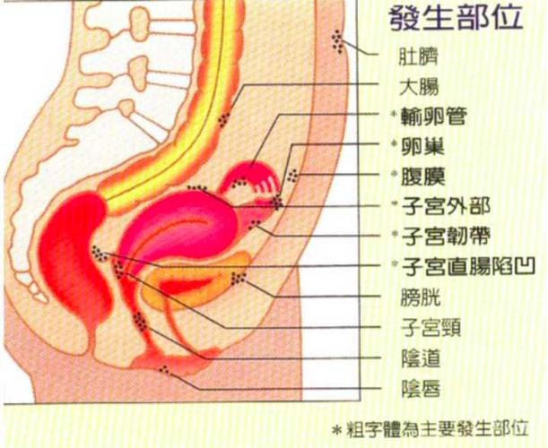 子宫内膜异位症容易怀孕吗?
