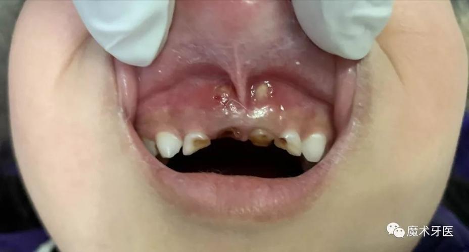 乳牙根尖周炎破坏牙槽骨并穿破粘膜