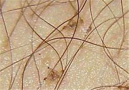 阴虱会爬入体内吗阴虱居然这么可怕