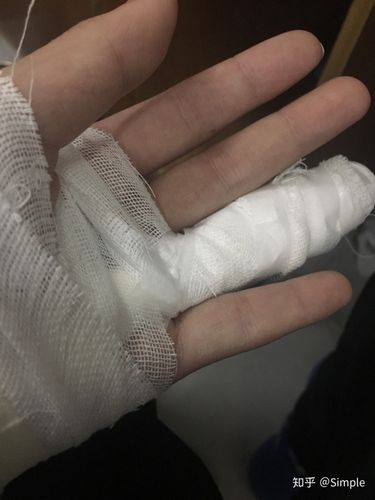 手指头骨折是种怎样的体验