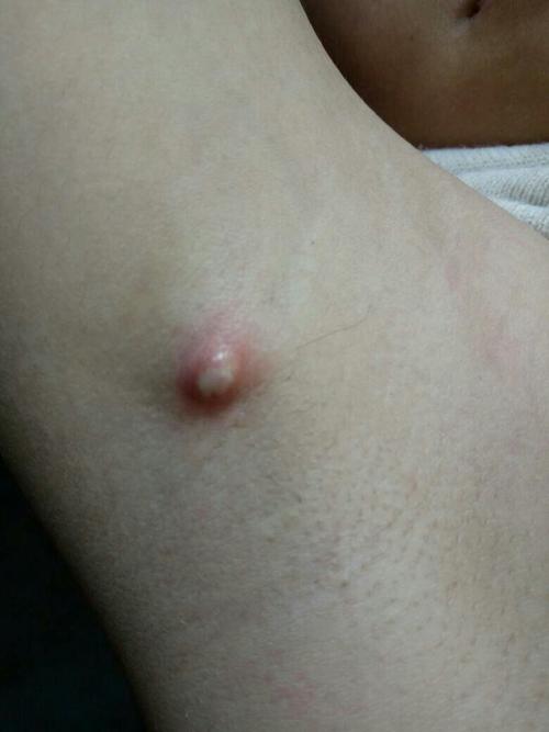 腋下长了一个小疙瘩,怎么办? 下有图片