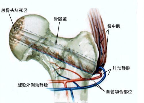 股骨头坏死是严重的骨伤科疾病,可带来剧烈疼痛,以及造成功能障碍