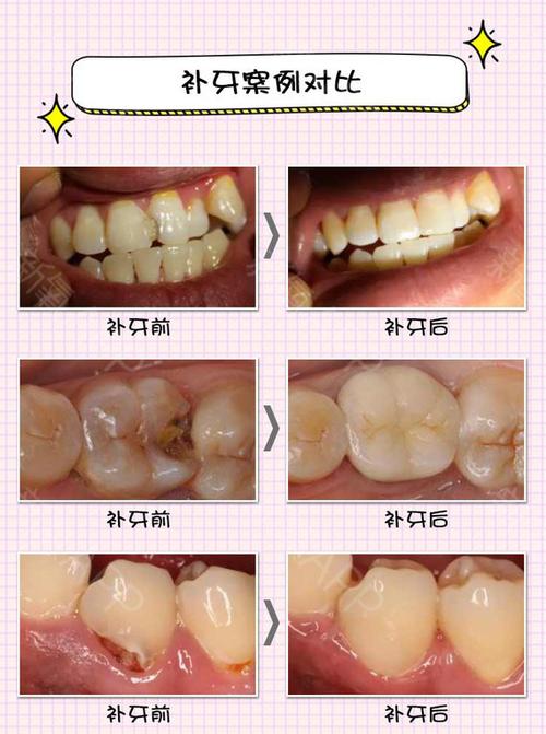 【补牙】日本进口可乐丽菲露树脂 中华口腔医学会@杨永利主任亲诊