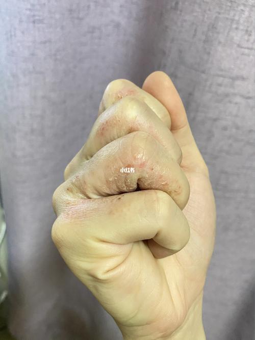手上长汗疱疹有什么办法可以彻底痊愈啊!