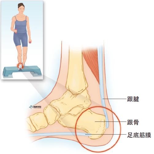 疼痛解剖学|跟骨骨刺综合征