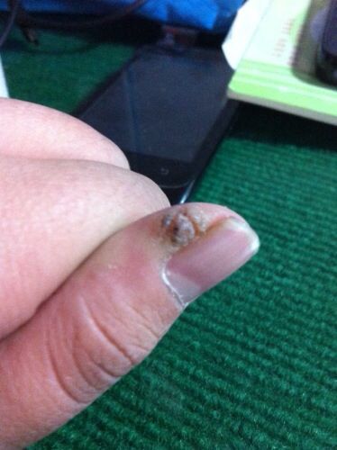 大拇指指甲周围长了个类似瘊子的东西,硬硬的,剪它的时候还疼,剪掉就