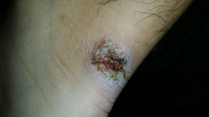 一开始是张了一个脓包,弄破了流出白水过一会自己又张