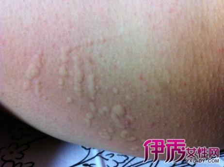 【图】小孩药物过敏症状图片怎么样 重要的是注意休息和多喝开水