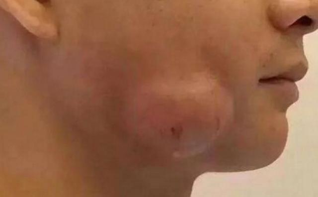 男子一觉睡醒脸肿了,医院检查后,里面居然取出来一东西