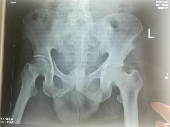 男,49岁,骨盆,双侧耻骨坐骨支骨折!