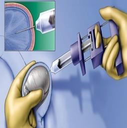 内单精子显微注射 选择性多胎妊娠减胎术 胚胎冻融 精液冻融 睾丸穿刺