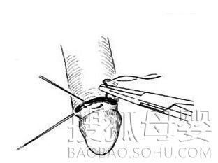 医学图解:包皮环切手术全过程