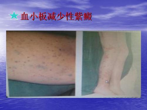 血小板减少性紫癜