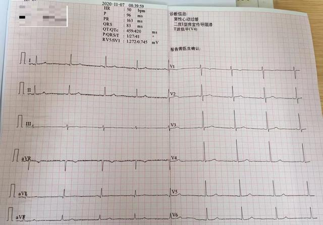 心电图t波低平就是冠心病?