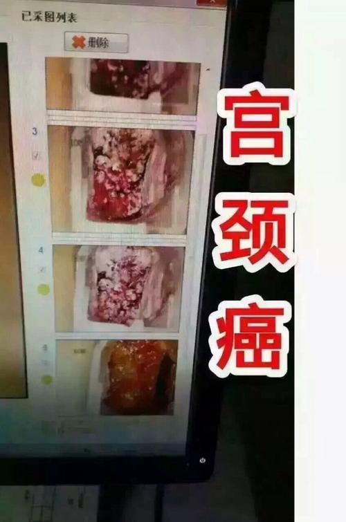 宫颈糜烂反馈集 棒女郎女神泡泡