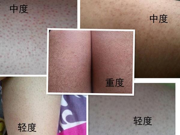 鸡皮肤有严重的色素怎么消除鸡皮肤红点真的很难看