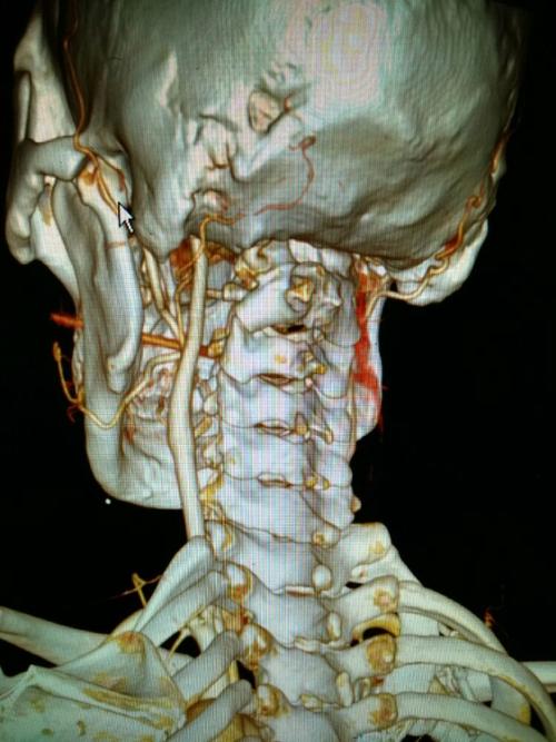 左侧椎动脉在环椎横突水平向上弯曲,右侧椎动脉发育欠佳.