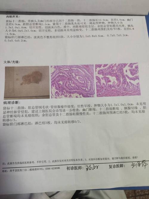 术后病理证实胆总管管状腺瘤伴癌变