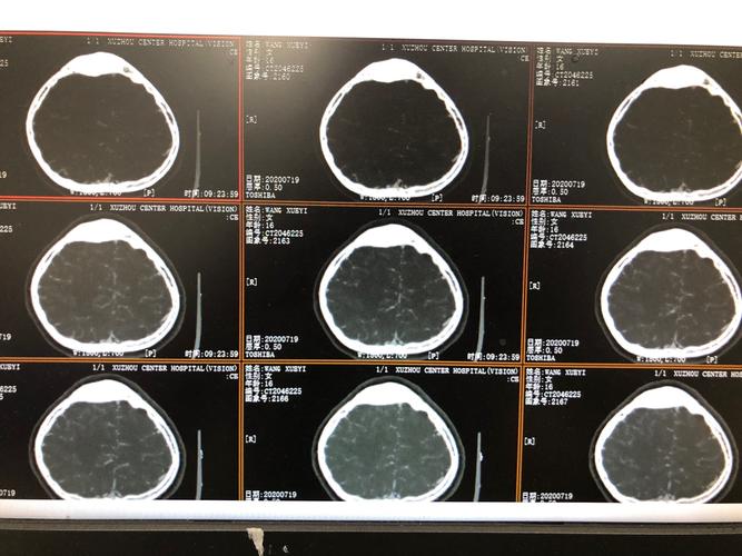 右侧侧脑室占位