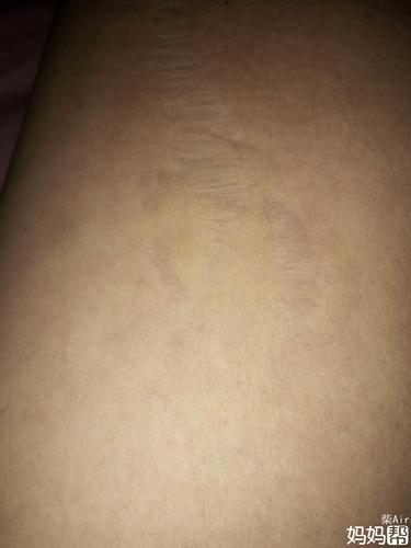 亲们帮忙看看这个是我老公大腿内侧长的东西不知道是什么像里面的肉没