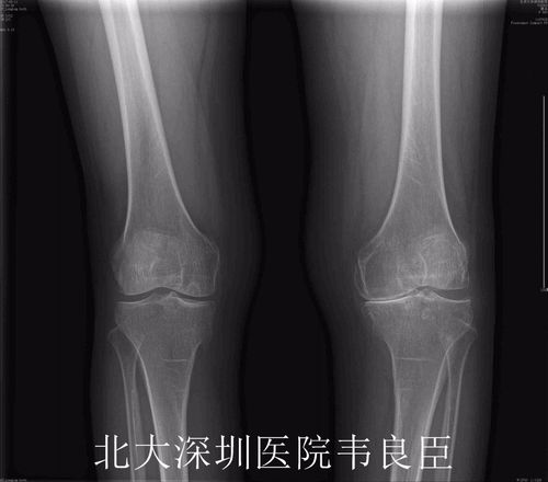 膝关节表面置换术x片示例