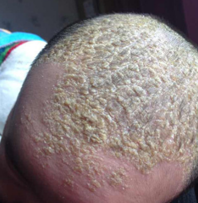 你的脂溢性皮炎,可以这么搞好!