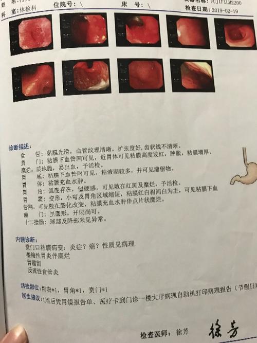 有在线的医生帮忙解答吗,中度萎缩性胃炎伴糜烂,肠化