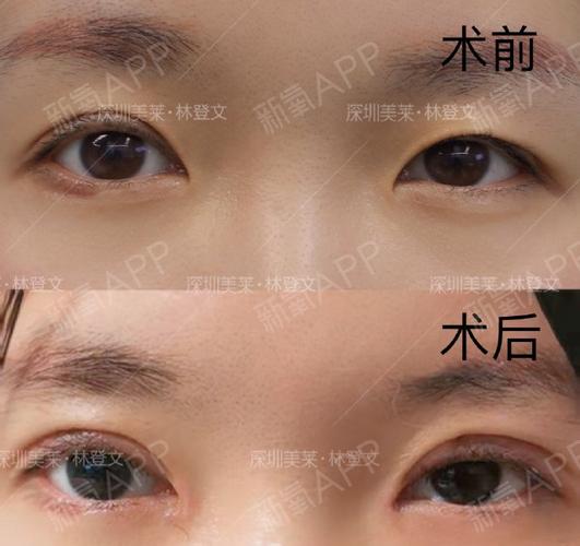 顾客由于小时候长麦粒肿造成睫毛上方的瘢痕明显而且