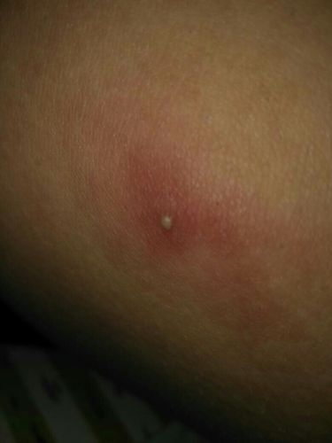 请问这是疮吗 或者脓?长在大腿上,发热 有点硬 也有点痛