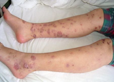 白塞病又称作是白塞氏病,是一种全身性的免疫系统的疾病,属于血管炎一