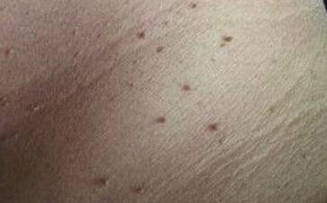 丝状疣初期图片