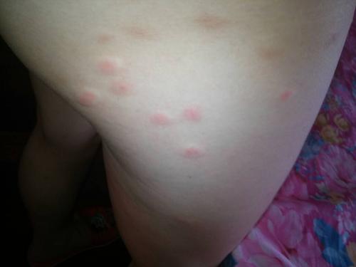 问:请问一下医生朋友们,这是虫咬的还是过敏发出来的,睡了一晚上早上