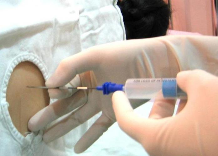 做剖腹产打麻醉,以后会对腰有影响吗?