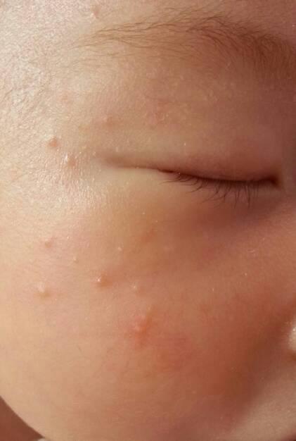 新生儿25天,脸上起了很多痘痘,像水泡里面还有白点还泛红,身上没有,这