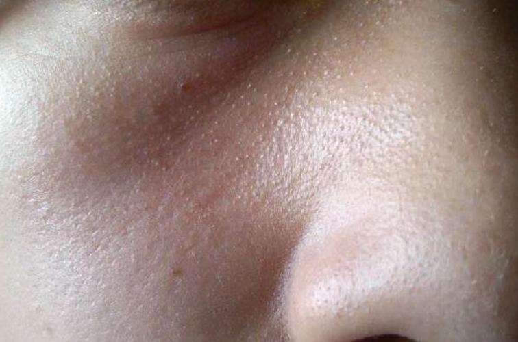 脸上像鸡皮肤疙瘩图片