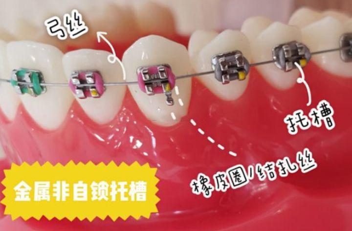 超级干货!所有牙套种类的优缺点分析,价格对比