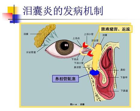 溢脓,指压泪囊区有脓性分泌物自泪囊经泪小管返流进入结膜囊