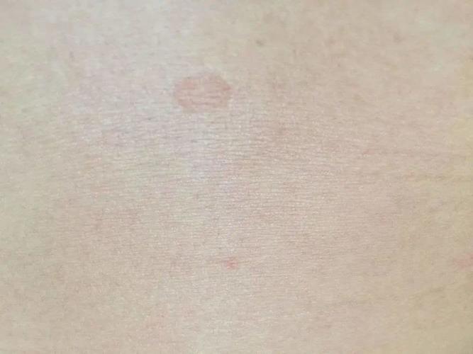 一到夏天前胸后背腋窝出现褐色圆形斑,是啥?会不会传染?