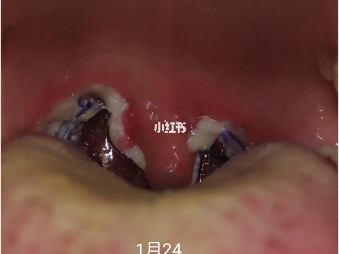 扁桃体术后白膜脱落过程图