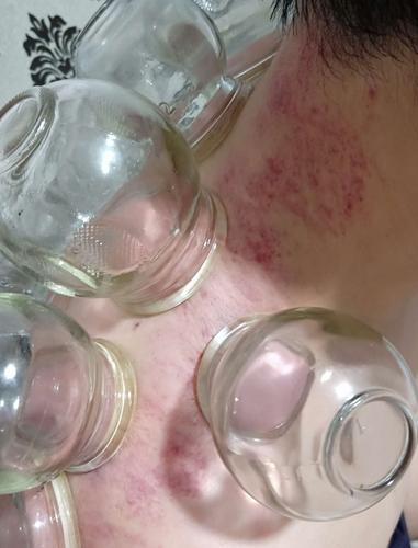 第二次刮痧:试刮部位疼痛减轻,刮痧后为患者实施拔罐,患者明显感觉