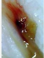 血块)可有下面几种情况:     第一,痰中带鲜红血丝,多见于肺结核或支