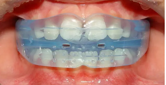 福州登特口腔专家介绍:mrc牙齿矫正——让孩子拥有完美脸型的秘密