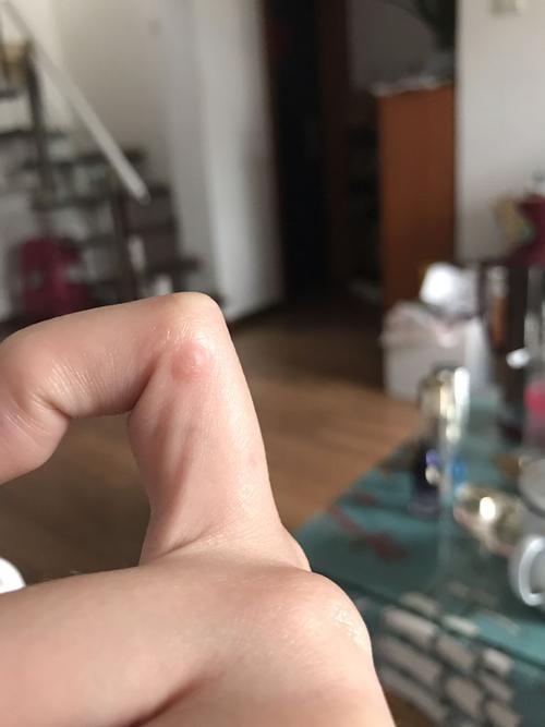 手上长了鱼鳞痣 这个痣很多年了 割掉厚又长了 要是别人看到我手上有