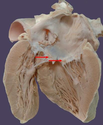 a,白色血栓 b,红色血栓 c,透明血栓 d,混合血栓