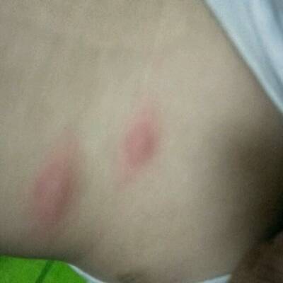 宝宝快九个月了昨天脸上出了红疙瘩就像蚊子咬的,没太