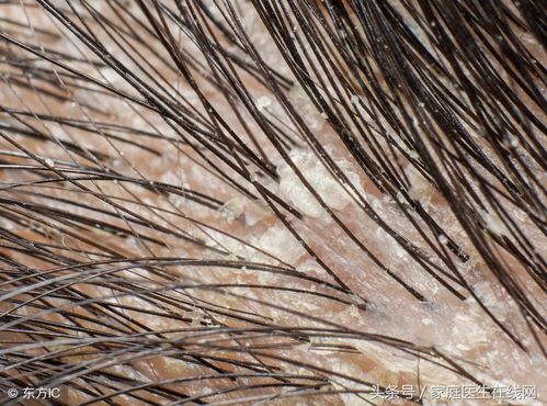 头皮屑多是什么病,3个原因导致的头癣