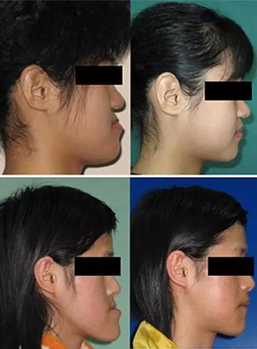 "地包天"手术前(左)后(右)