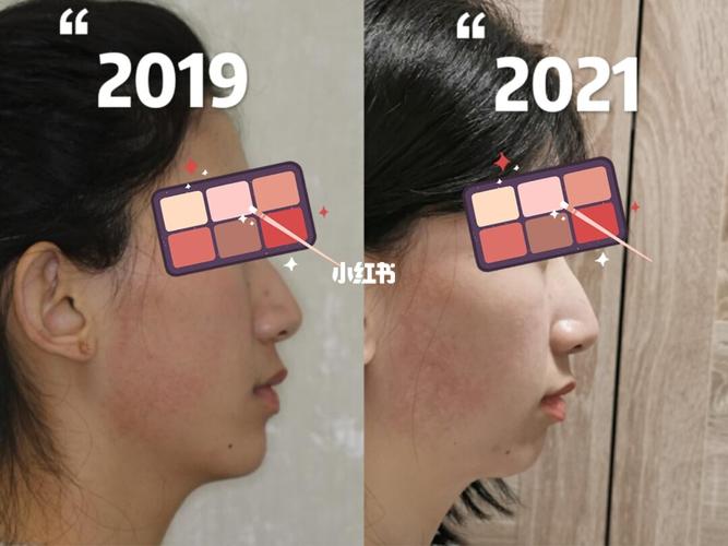 正畸正的下巴没了_正畸_牙套_牛肉干_脸型_拔牙_美妆